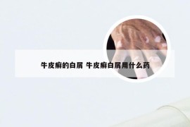 牛皮癬的白屑 牛皮癬白屑用什么藥